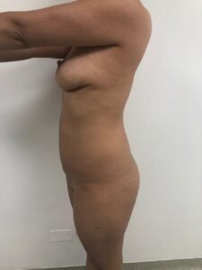 Colcirugia-Abdominoplastia-02