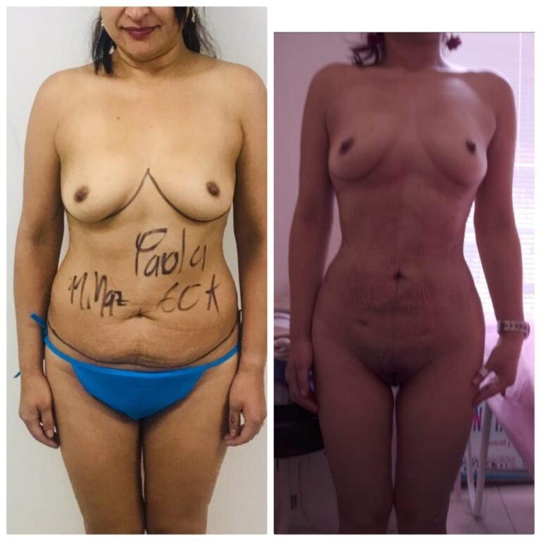 Colcirugia-Abdominoplastia-03