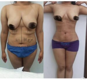 Colcirugia-Abdominoplastia-04