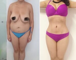 Colcirugia-Abdominoplastia-05