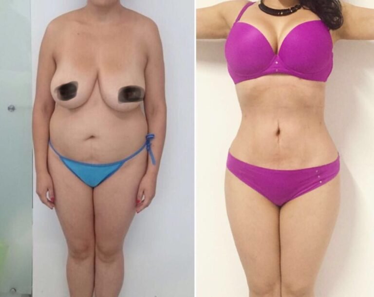 Colcirugia-Abdominoplastia-05