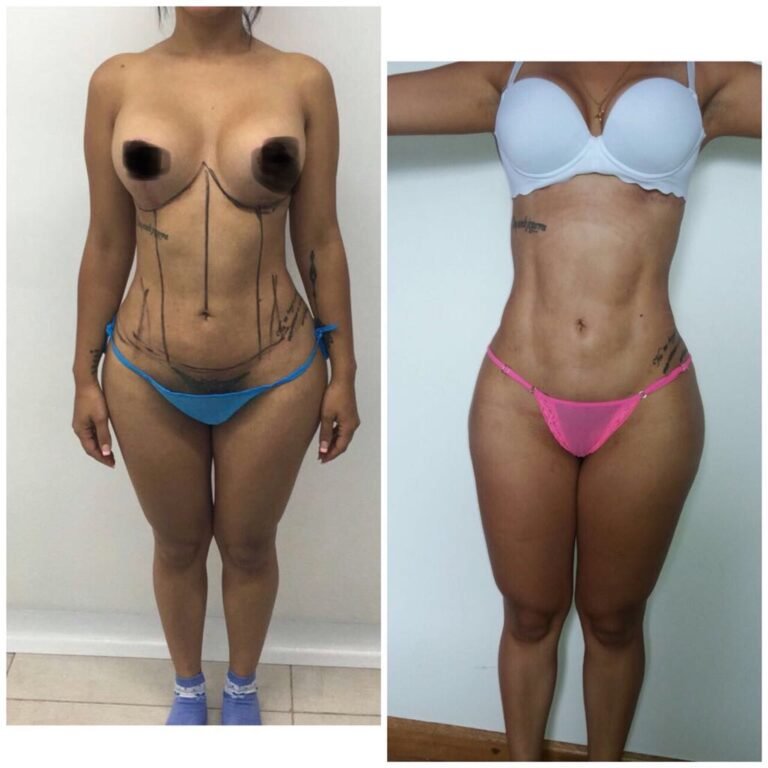 Colcirugia-Abdominoplastia-06