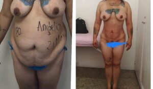 Colcirugia-Abdominoplastia-10