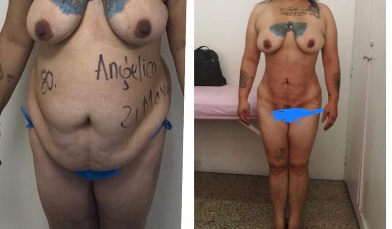 Colcirugia-Abdominoplastia-10