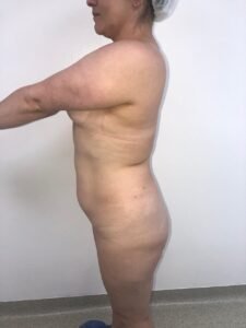 Colcirugia-Abdominoplastia-11