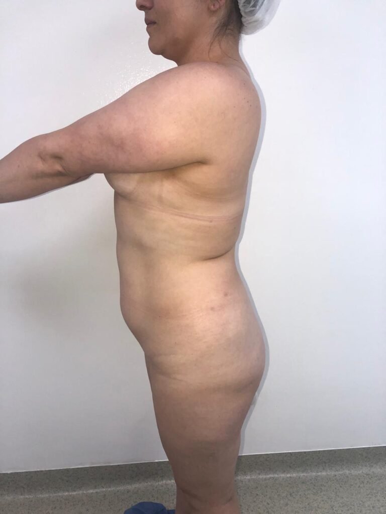 Colcirugia-Abdominoplastia-11