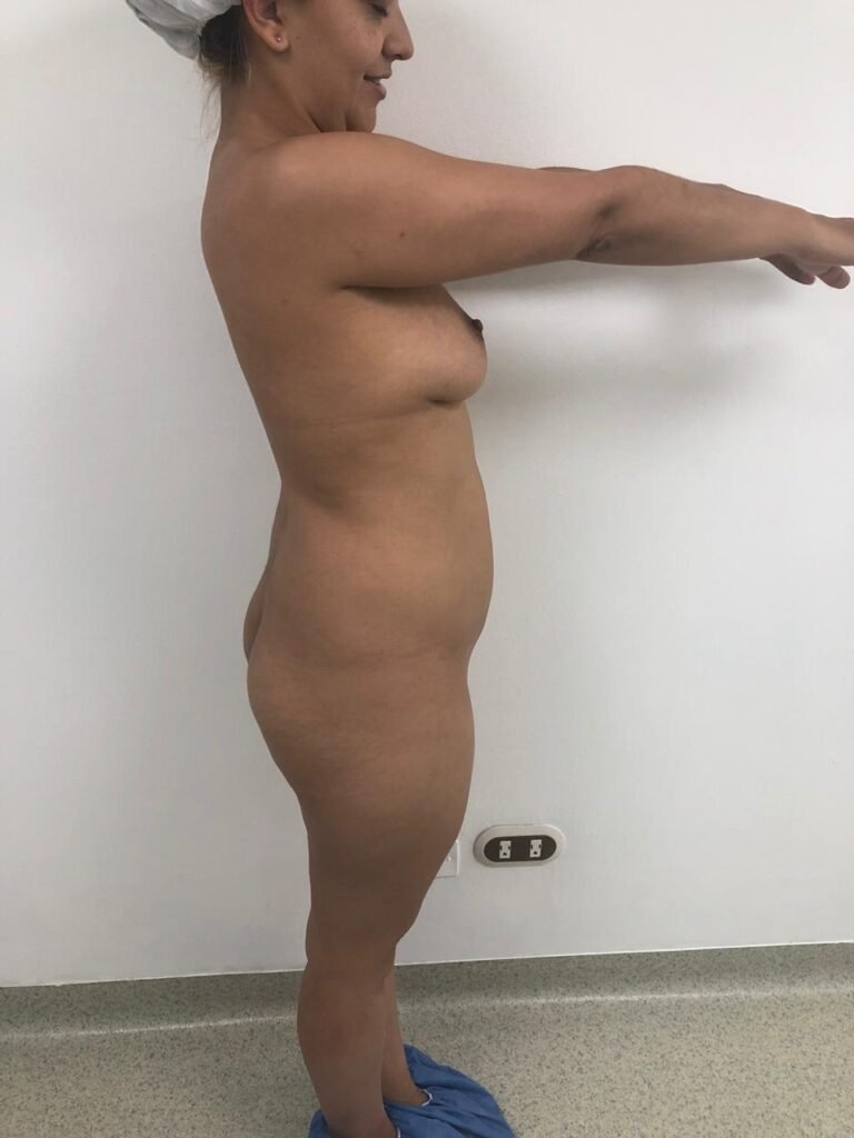 Colcirugia-Abdominoplastia-12