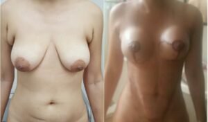 Colcirugia-AumentoMamario-01