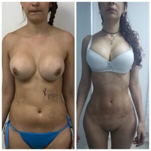 Colcirugia-AumentoMamario-02