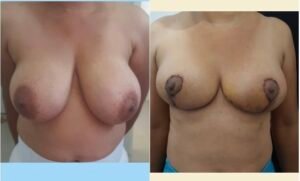 Colcirugia-AumentoMamario-08