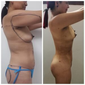 Colcirugia-AumentoMamario-09