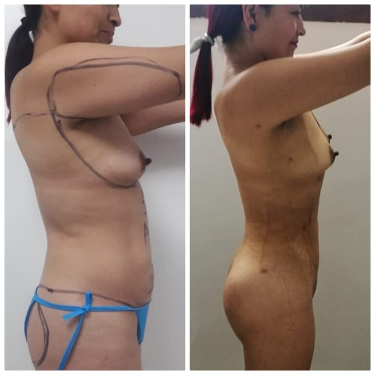 Colcirugia-AumentoMamario-09