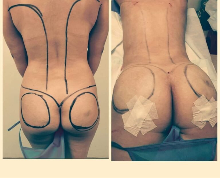 Colcirugia-ColaBBL-04