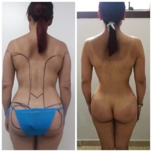 Colcirugia-ColaBBL-05