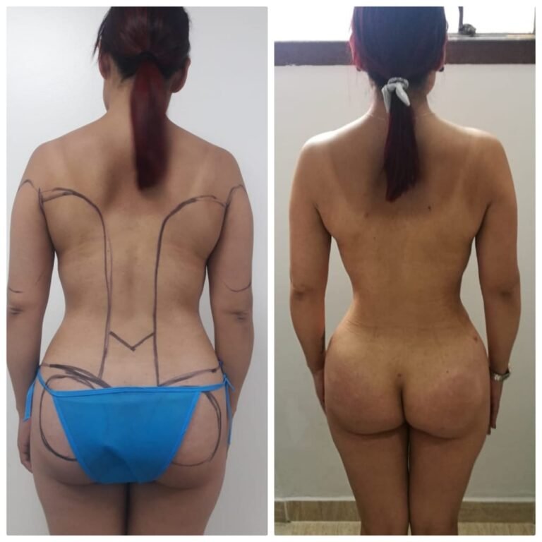 Colcirugia-ColaBBL-05