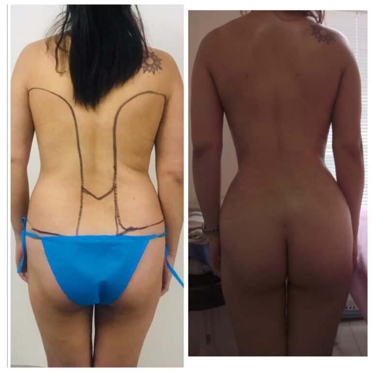 Colcirugia-ColaBBL-06