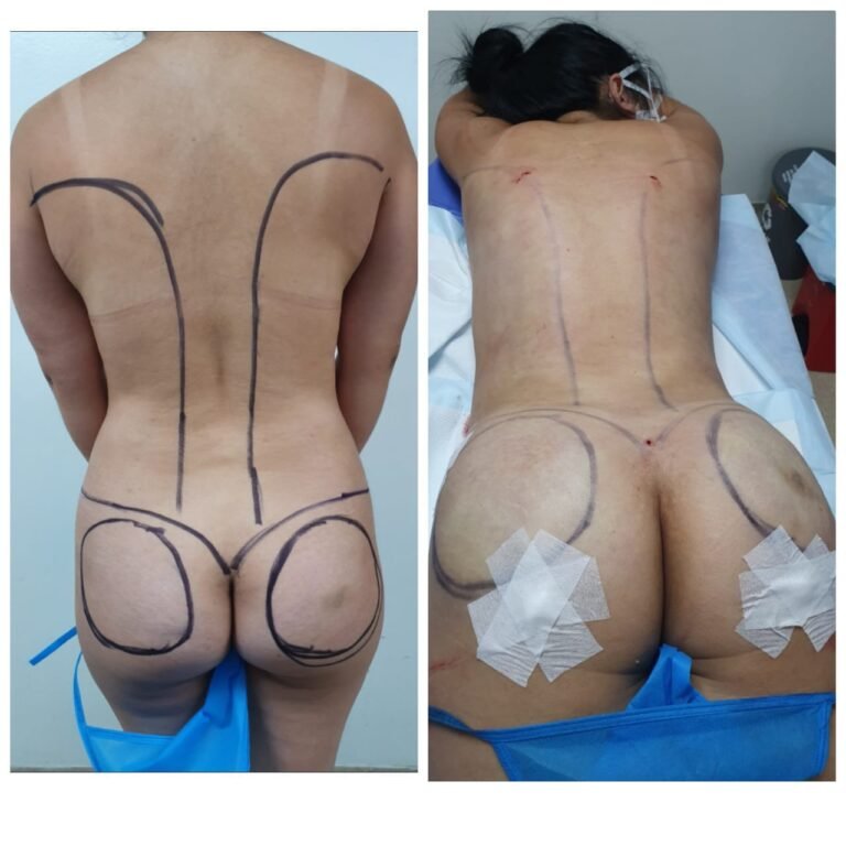 Colcirugia-ColaBBL-08