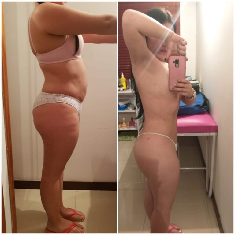 Colcirugia-Liposuccion-02