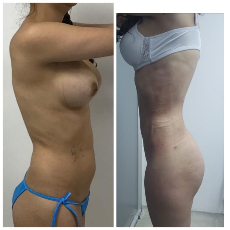 Colcirugia-Liposuccion-04