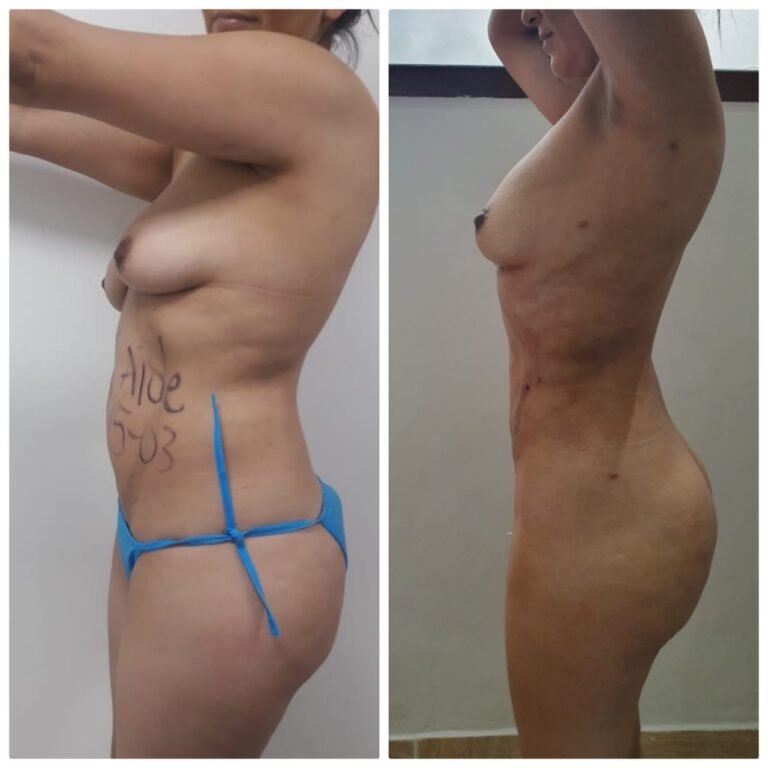 Colcirugia-Liposuccion-05