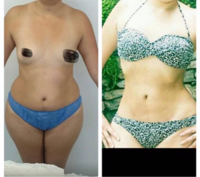 Colcirugia-Liposuccion-08