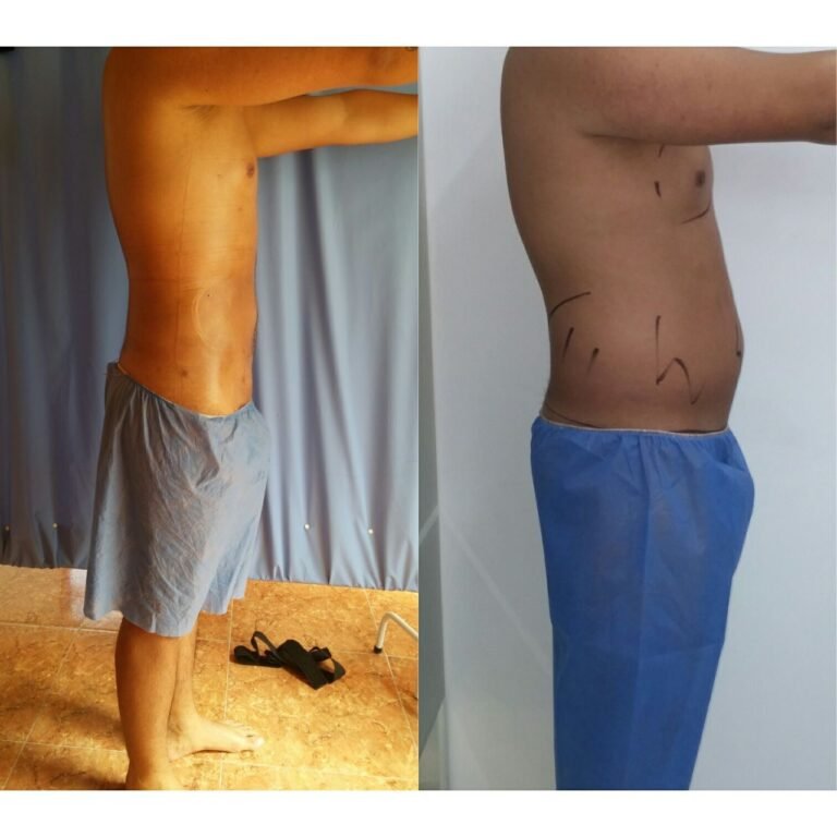 Colcirugia-Liposuccion-09