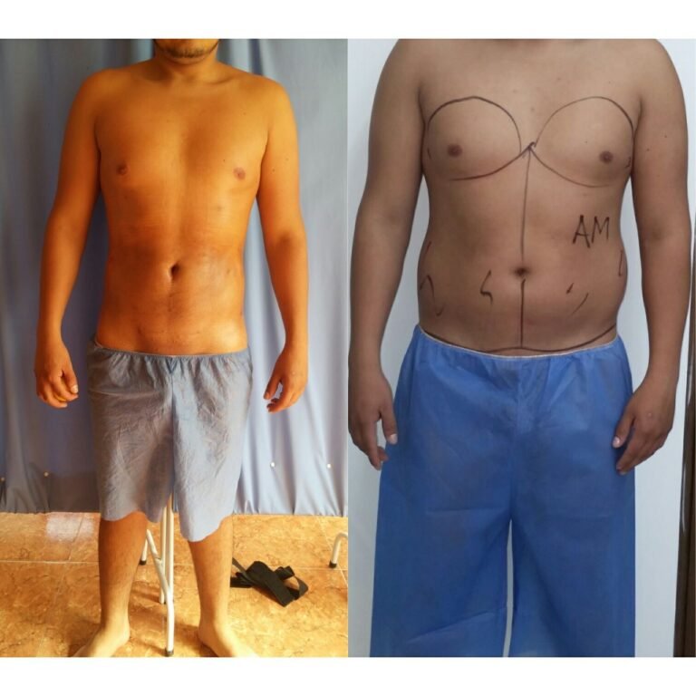 Colcirugia-Liposuccion-10