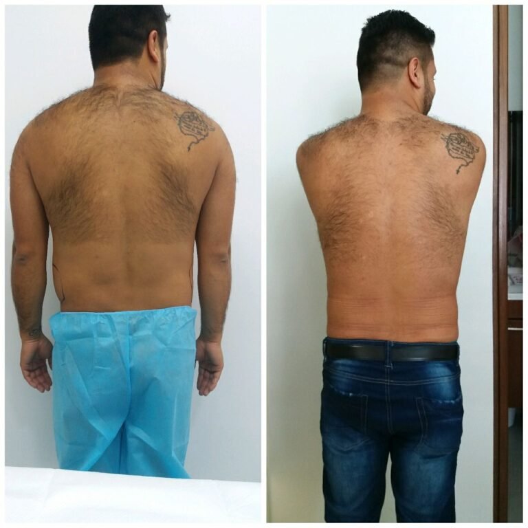 Colcirugia-Liposuccion-11