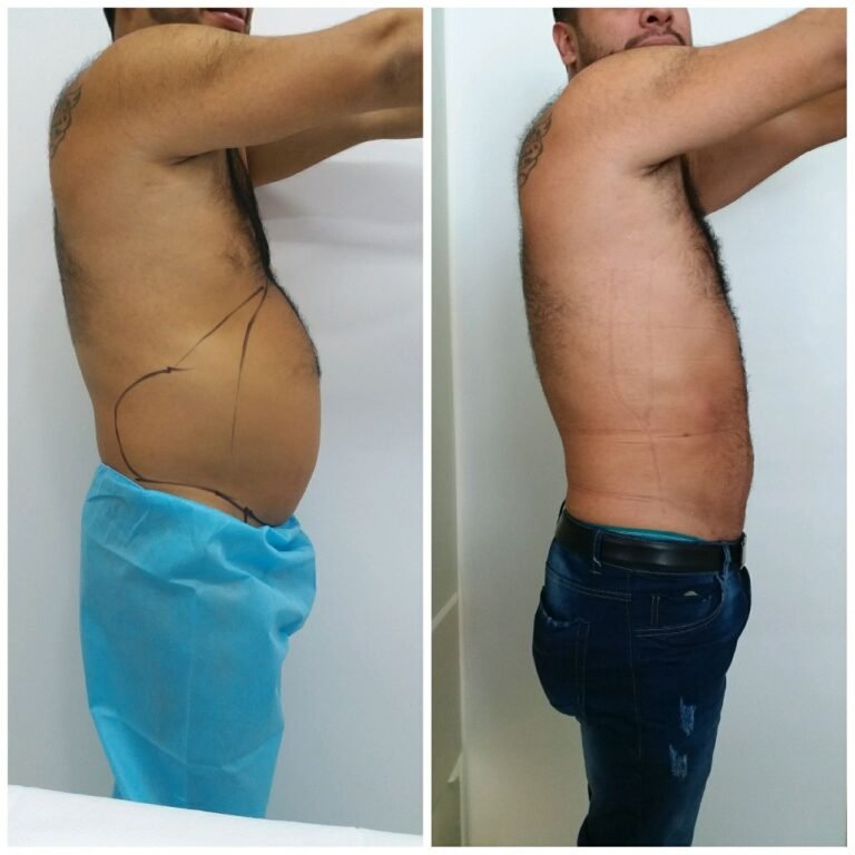 Colcirugia-Liposuccion-12