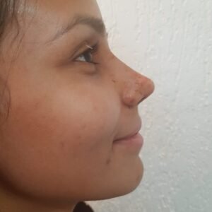 Colcirugia-Rinoplastia-02