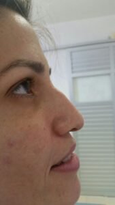 Colcirugia-Rinoplastia-03