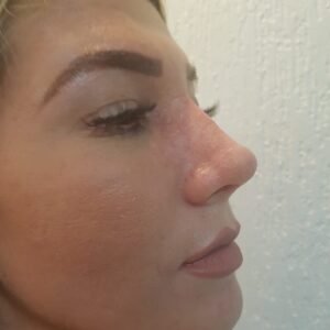 Colcirugia-Rinoplastia-04