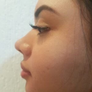 Colcirugia-Rinoplastia-08