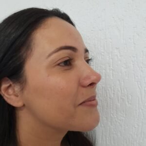 Colcirugia-Rinoplastia-09
