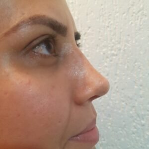 Colcirugia-Rinoplastia-10