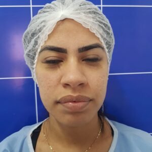 Colcirugia-Rinoplastia-12