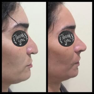 Colcirugia-Rinoplastia-13