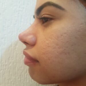 Colcirugia-Rinoplastia-14