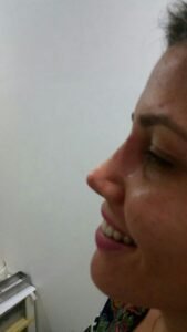 Colcirugia-Rinoplastia-17