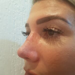 Colcirugia-Rinoplastia-22