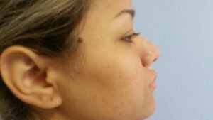 Colcirugia-Rinoplastia-23